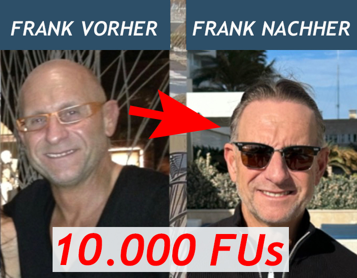Haartransplantation mit FUE & 10.000 Grafts auf eine Glatze - Frank Haartransplantation mit FUE & 10.000 Grafts auf eine Glatze - Frank