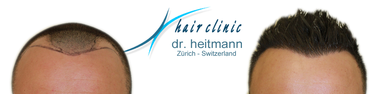  Haartransplantation Kosten Und Preise Schweiz Info Ch